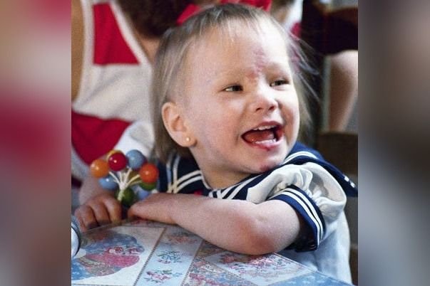 Jessica McClure as a toddler with visible forehead scar after the 1987 well rescue